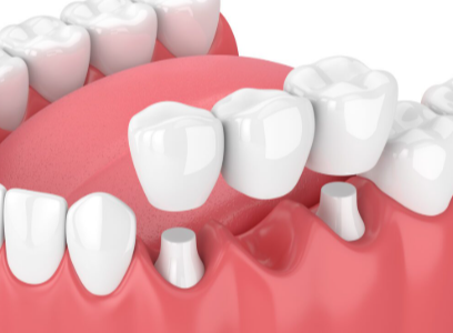 Composite Bonding: Bridging Modern Aesthetics with Natural Texture