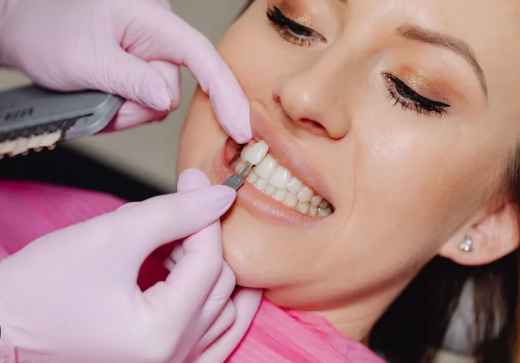 Understanding the Cost of Veneers for a Brighter Smile